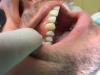 nasadená kovokeramická korunka na implantáte v mieste chýbajúceho zuba 15