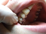 hotová korunka po fixácii v ústach